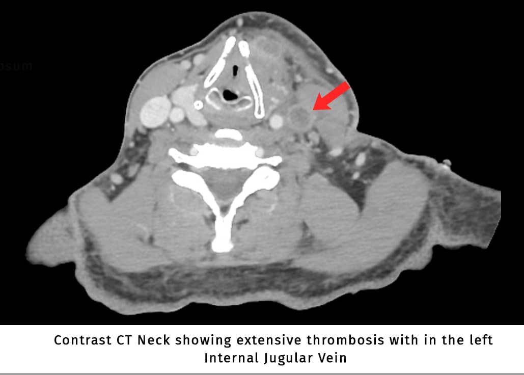 Lemierre syndrome