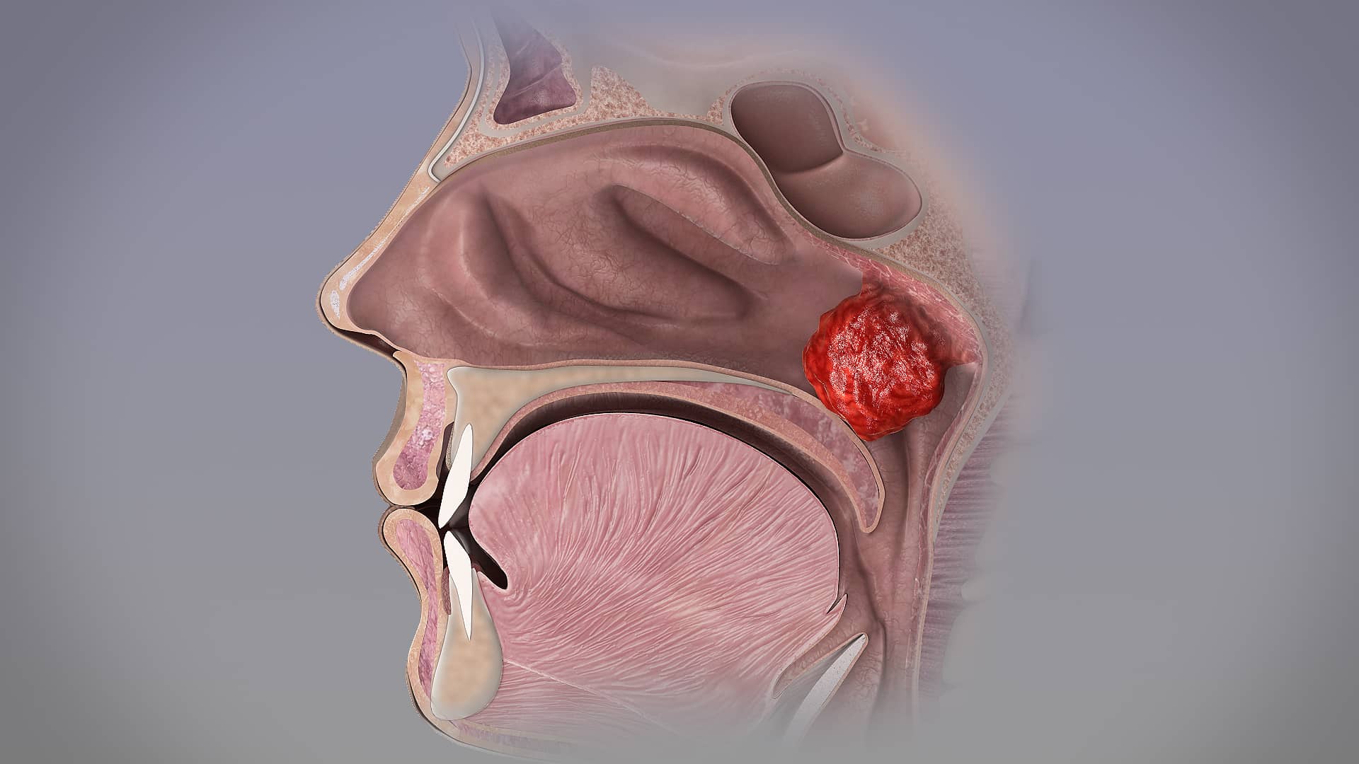 What are adenoids? Adenoid Hypertrophy, Clinical features and Adenoidectomy