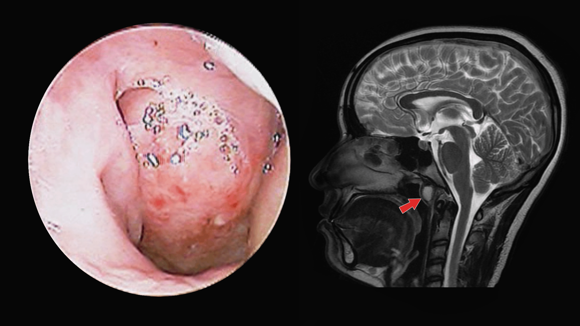 Tornwaldt cyst