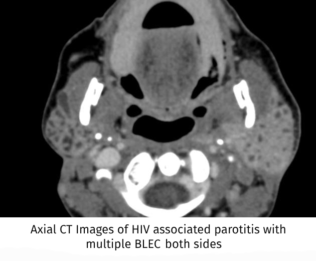 HIV-Parotitis