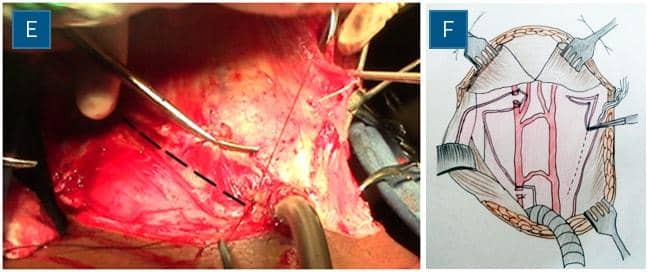 Total larngectomy steps