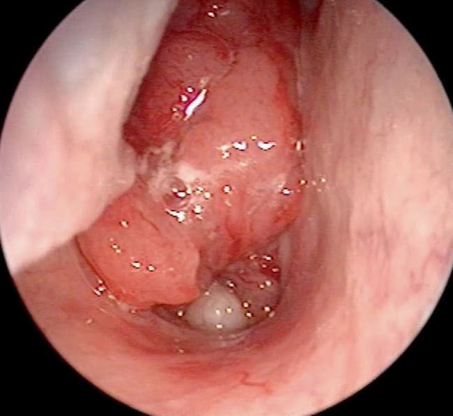 TNM Staging of Nasopharyngeal Carcinoma (AJCC 8)