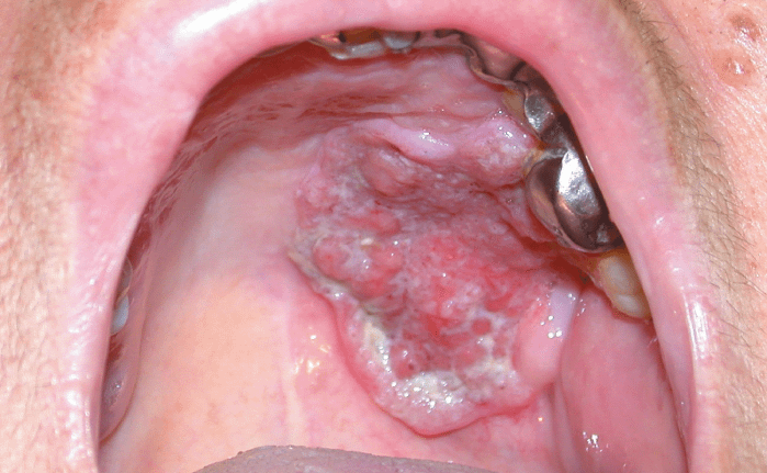 oropharyngeal cancer