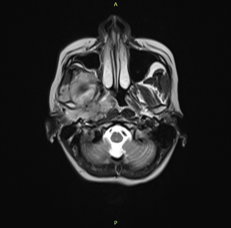 Staging systems for Juvenile Nasopharyngeal Angiofibroma