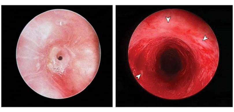 Replacement of trachea with aortic grafts – a novel treatment for tracheal stenosis