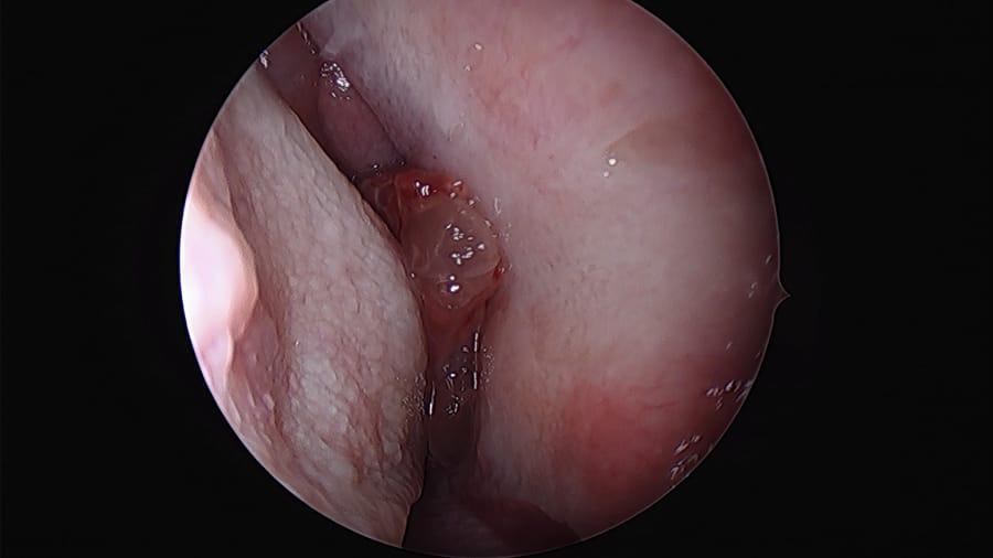 Inverted Papilloma – Clinical features, Diagnosis and Treatment