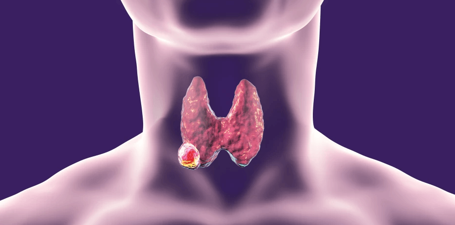 Thyroid cancer