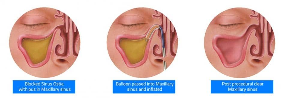 Schematic diagram of balloon dilatation for maxillary sinusitis