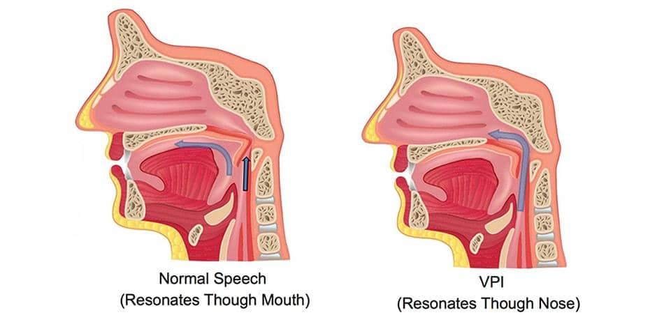 Velopharyngeal Insufficiency