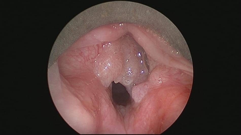 JORRP - Endoscopic finding