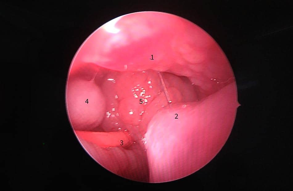 Submucosal cleft