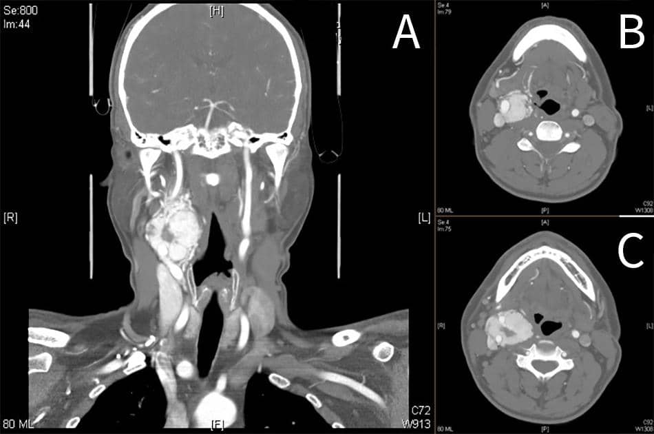 Carotid Body Tumors / Chemodectoma – Clinical features and Treatment